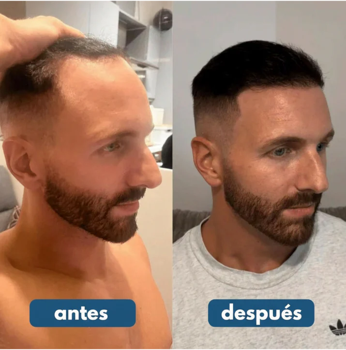 HairWise® Serum Roll-On - Crecimiento y Fortalecimiento capilar